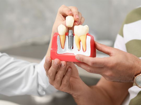 12985279 press release image for implant restoration